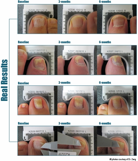 Laser Fungal Nail Results