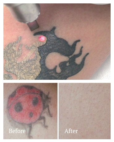 Laser Tattoo Removal - JKH Healthcare Laser Tattoo Removal - JKH Healthcare
